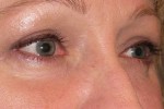 Eyelid and Upper Facial Surgery