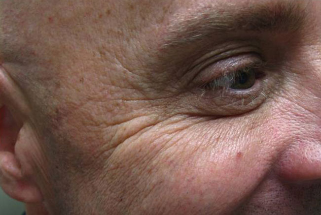 Botox, Daxxify, Dysport