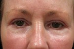 Eyelid and Upper Facial Surgery