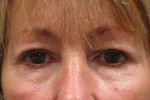 Eyelid and Upper Facial Surgery