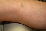 Sclerotherapy