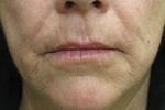 Skin Laser Resurfacing