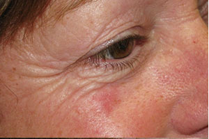 Skin Laser Resurfacing