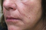 Skin Laser Resurfacing