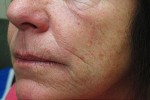 Skin Laser Resurfacing