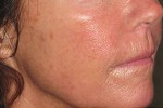 Skin Laser Resurfacing