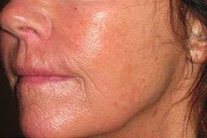 Cosmetic Laser before and after photo in Rhode island