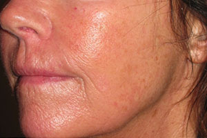 Skin Laser Resurfacing