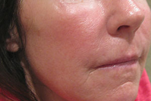 Skin Laser Resurfacing