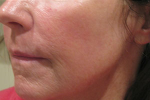 Cosmetic Laser before and after photo in Rhode island