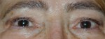 Eyeliner Micropigmentation