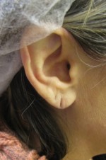 Earlobe Repair