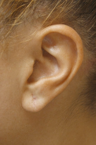 Earlobe Repair