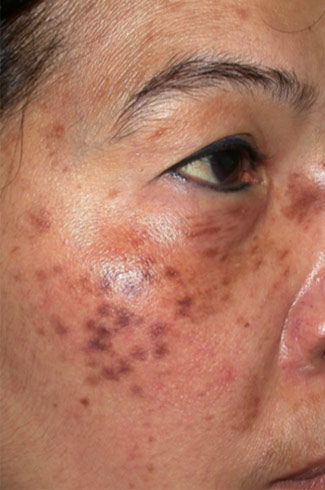 Laser to Remove Brown Spots