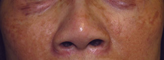 Laser to Remove Brown Spots