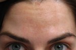 Botox, Dysport, and Xeomin