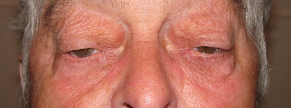 Eyelid and Upper Facial Surgery