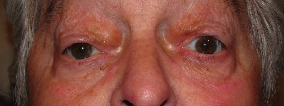 Eyelid and Upper Facial Surgery