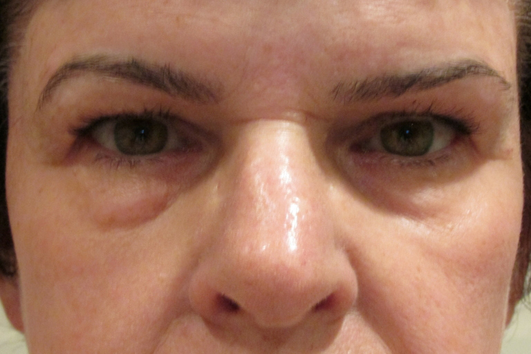 Eyelid and Upper Facial Surgery