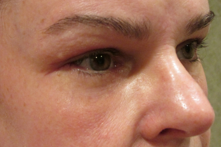 Eyelid and Upper Facial Surgery