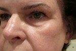 Eyelid and Upper Facial Surgery