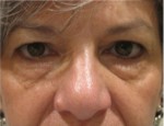 Eyelid and Upper Facial Surgery