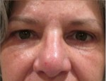 Eyelid and Upper Facial Surgery