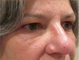 Eyelid and Upper Facial Surgery