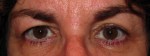 Eyelid and Upper Facial Surgery