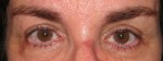 Eyelid and Upper Facial Surgery