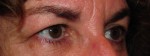 Eyelid and Upper Facial Surgery