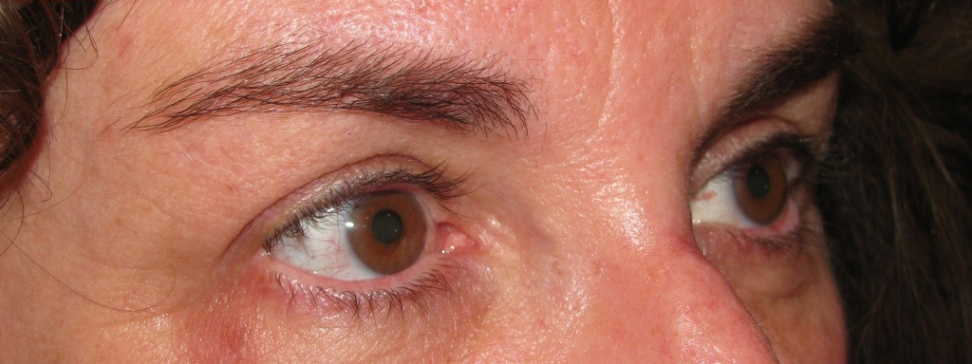 Eyelid and Upper Facial Surgery