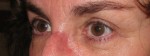 Eyelid and Upper Facial Surgery