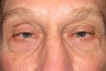 Eyelid and Upper Facial Surgery