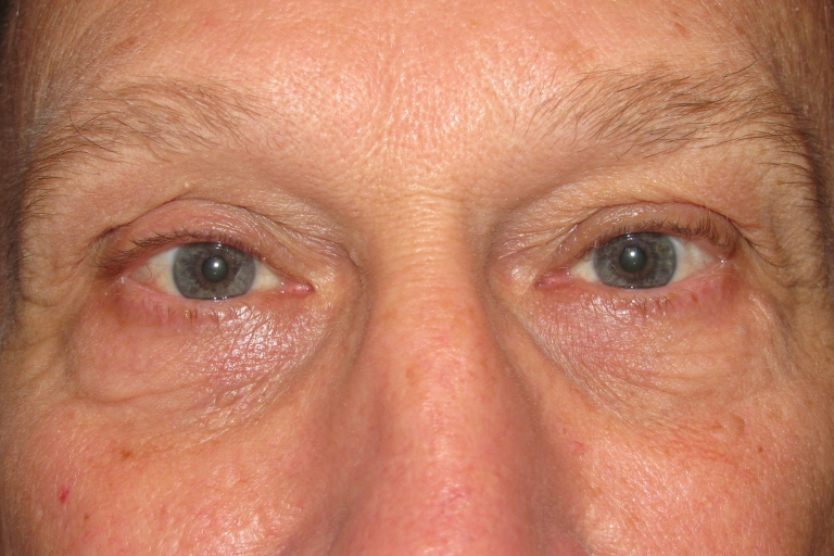 Eyelid and Upper Facial Surgery