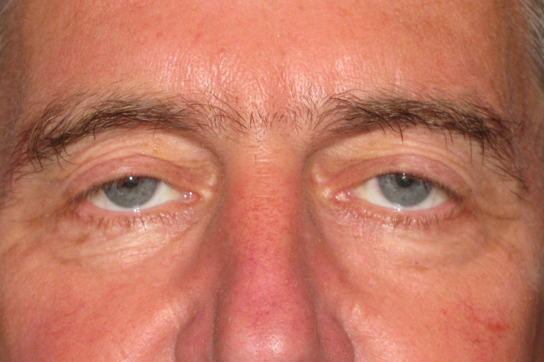 Eyelid and Upper Facial Surgery