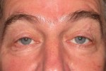 Eyelid and Upper Facial Surgery