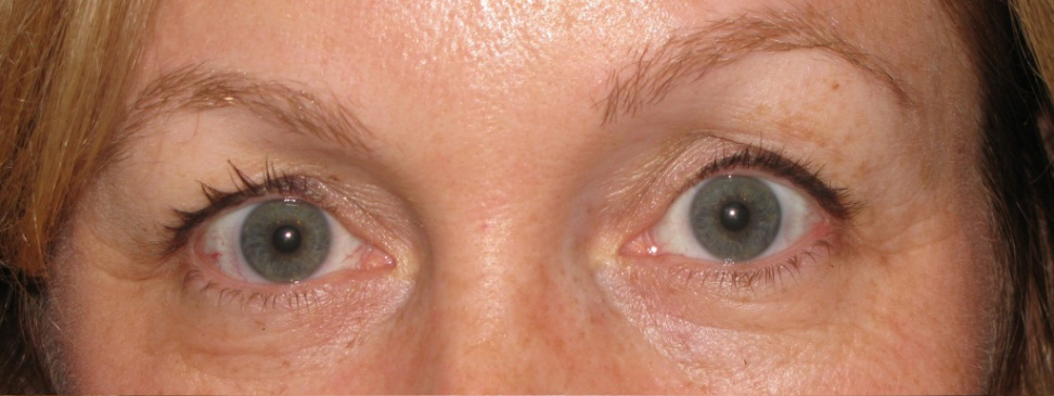 Eyelid and Upper Facial Surgery