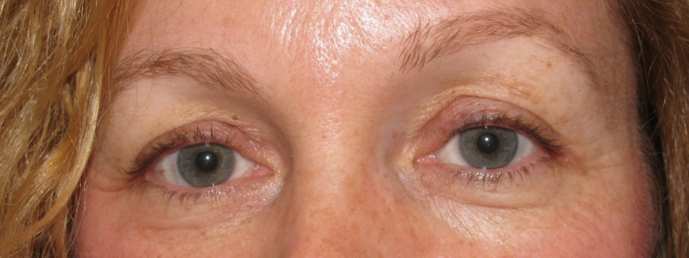 Eyelid and Upper Facial Surgery