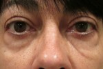 Eyelid and Upper Facial Surgery