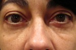 Eyelid and Upper Facial Surgery