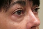 Eyelid and Upper Facial Surgery