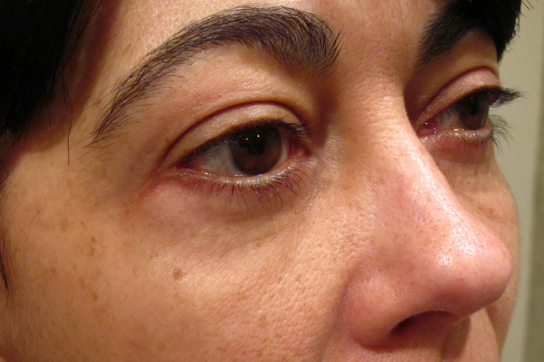 Eyelid and Upper Facial Surgery