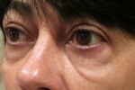 Eyelid and Upper Facial Surgery