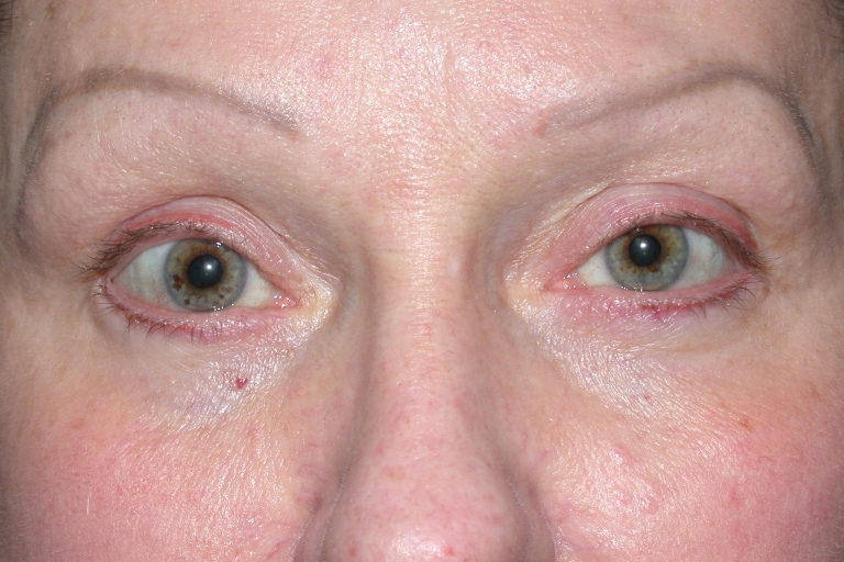 Eyelid and Upper Facial Surgery