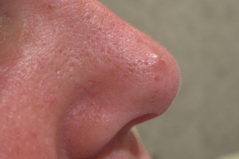 Removal of Skin Growths