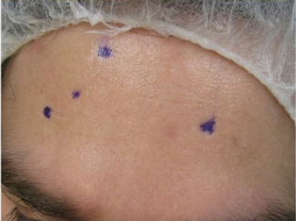 FaSula Scar Surgery