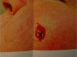 Skin Cancer Reconstruction