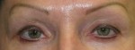 Eyeliner Micropigmentation