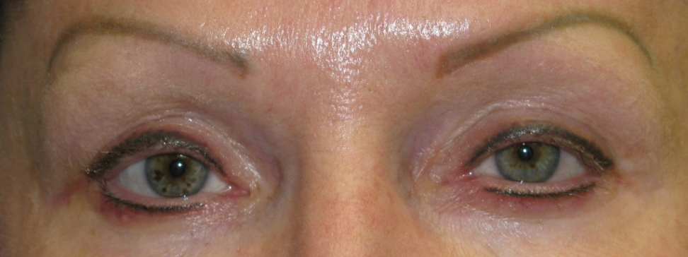 Eyeliner Micropigmentation